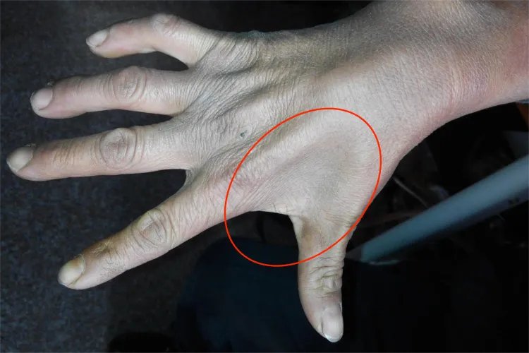 手虎口处肌肉塌陷图片