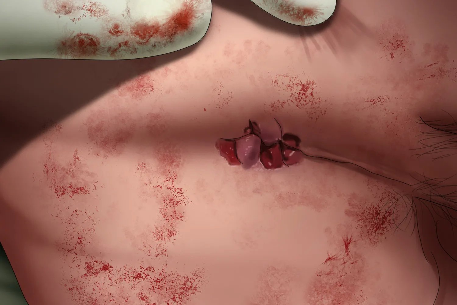 痔疮手术后的伤口图片