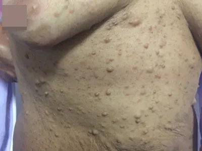 咖啡斑症状图片