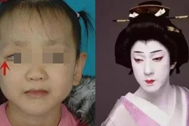 歌舞伎综合征宝宝照片