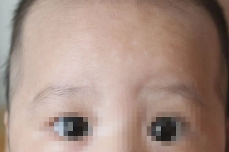 小孩身上有白斑图片
