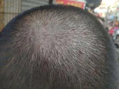 念珠状发症状图片