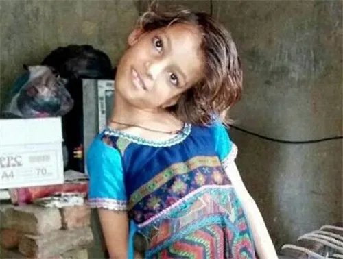 女孩头部无法竖立 被称为罪恶象征,村民害怕的瑟瑟发抖