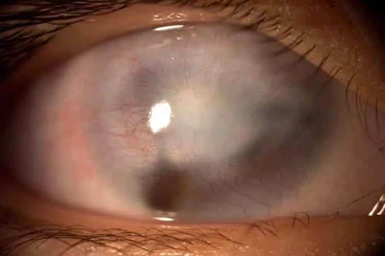 儿童角膜炎的症状图片