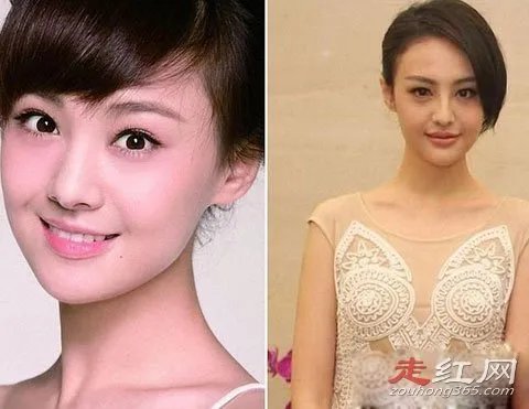 郑爽整容了吗 取出假体前后对比照片