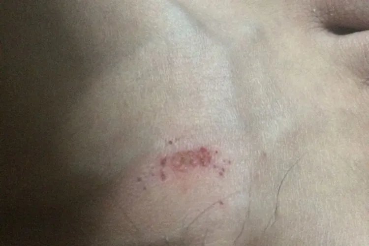 脚面上起了一片小红疹图片