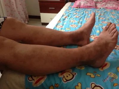 家族性进行性色素沉着症斑图片