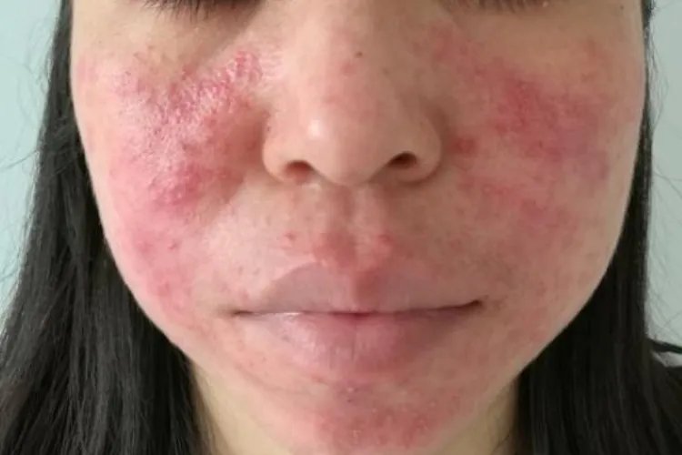 脸的两侧发红还有小疙瘩图片