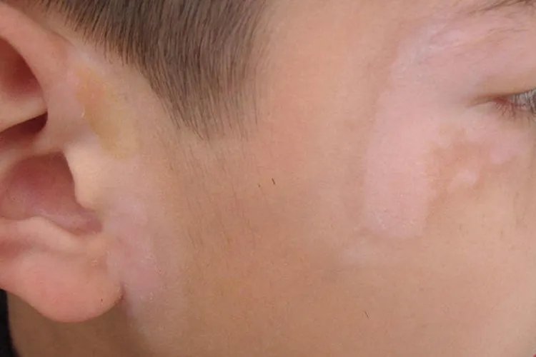 小孩身上有白斑图片