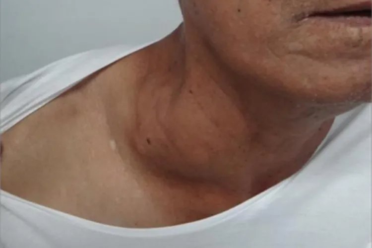 登革热症状图片