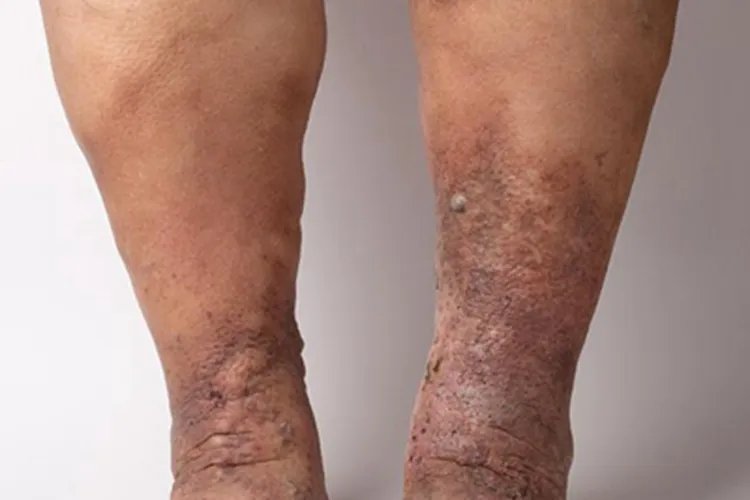 肢端肥大症症状图片