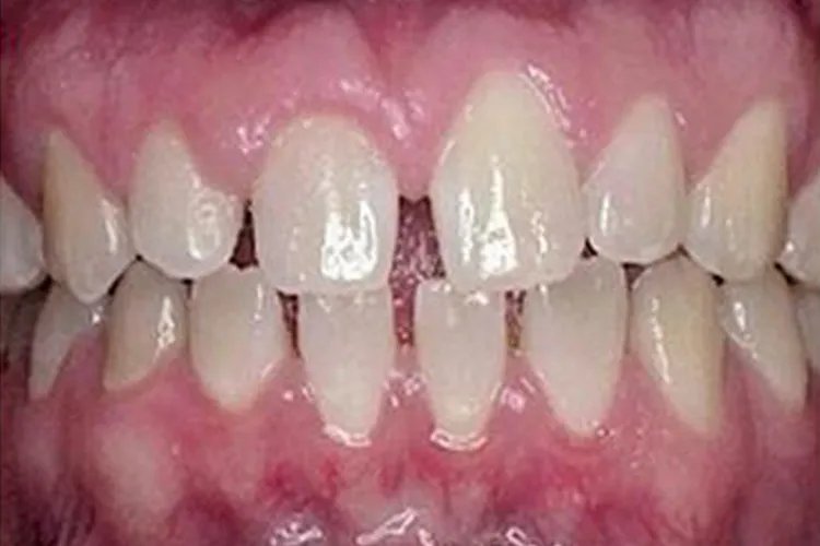 牙齿不平整图片