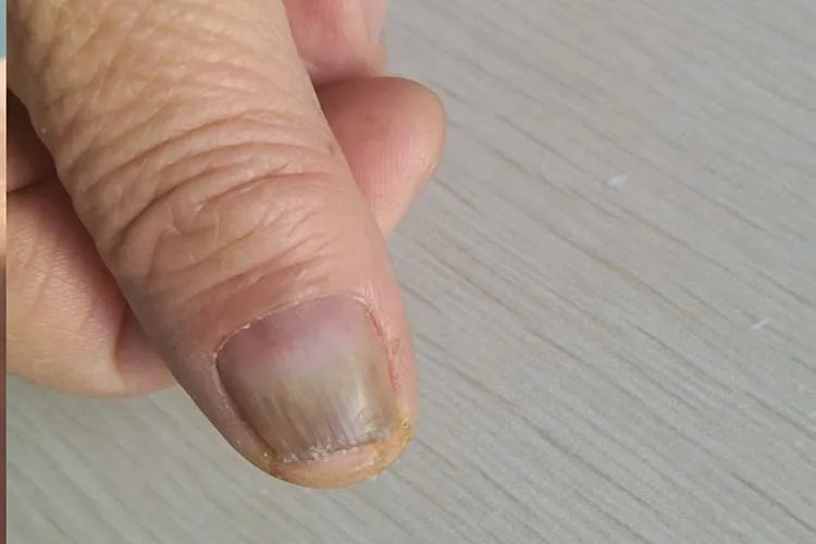 什么是灰指甲症状图片