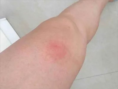 Ⅰ型痛性肥胖病症状图片