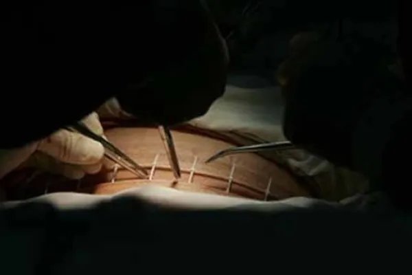 女子3次剖腹 打开肚子医生惊恐(图)