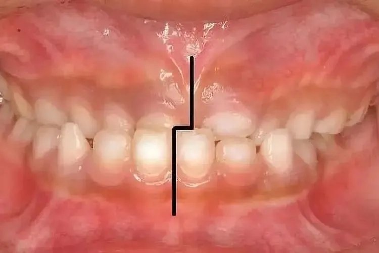 牙齿不平整图片