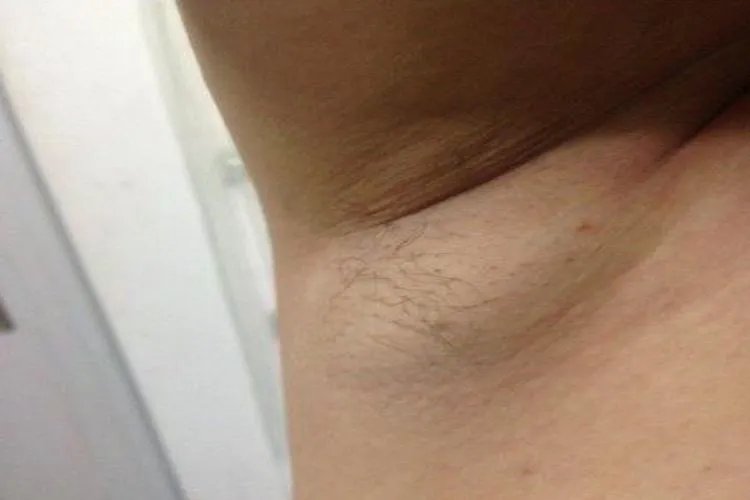 腋下淋巴癌明显的特点图片