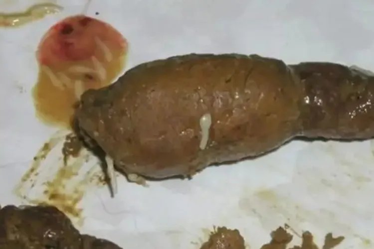绦虫病症状图片