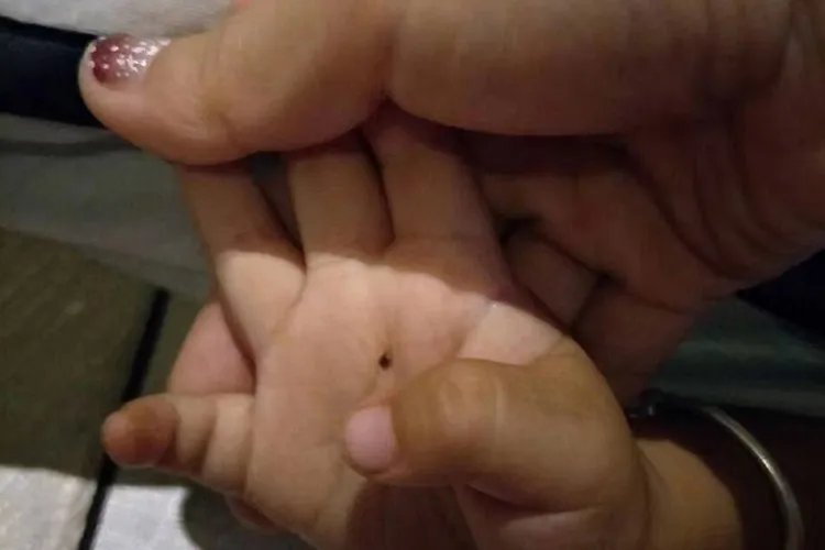 小孩手心长黑痣图片