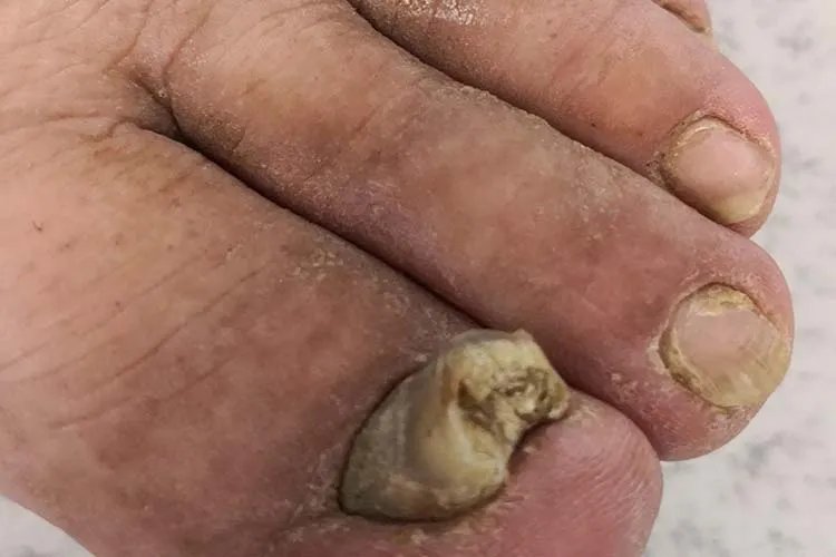 什么是灰指甲症状图片