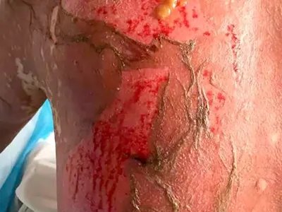 重型多形红斑型药疹背部糜烂图片