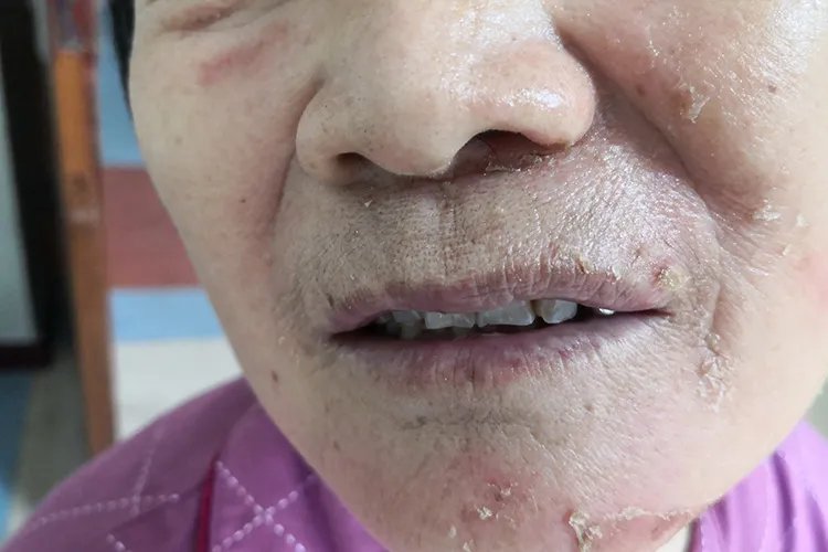 丹毒的症状图片