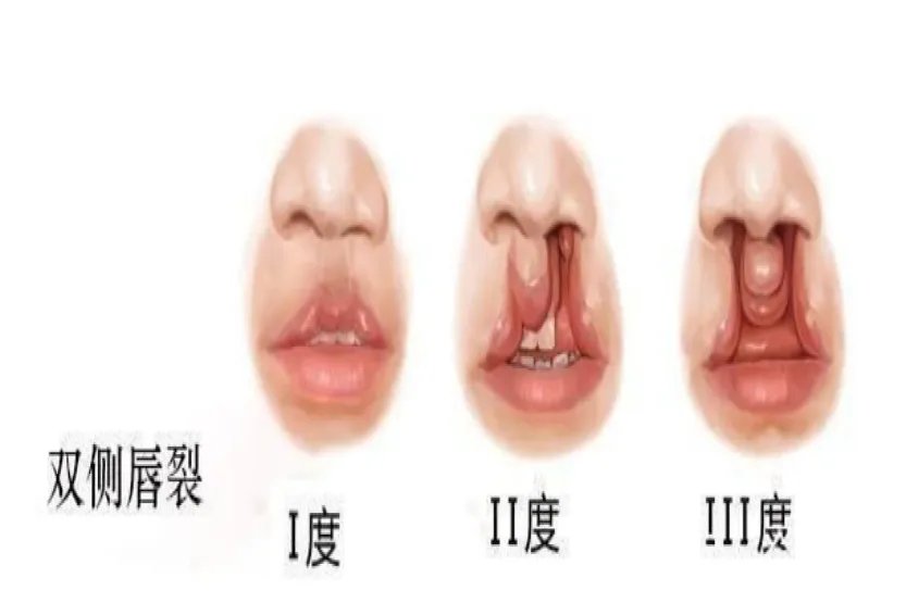 双侧唇裂图片