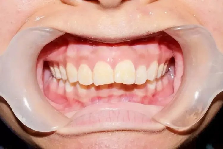 牙齿不平整图片