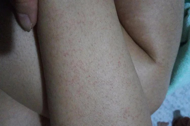 白血病早期出血点图片