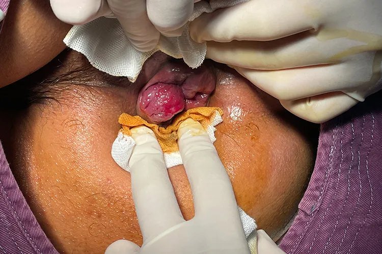 痔疮长在哪个位置图片