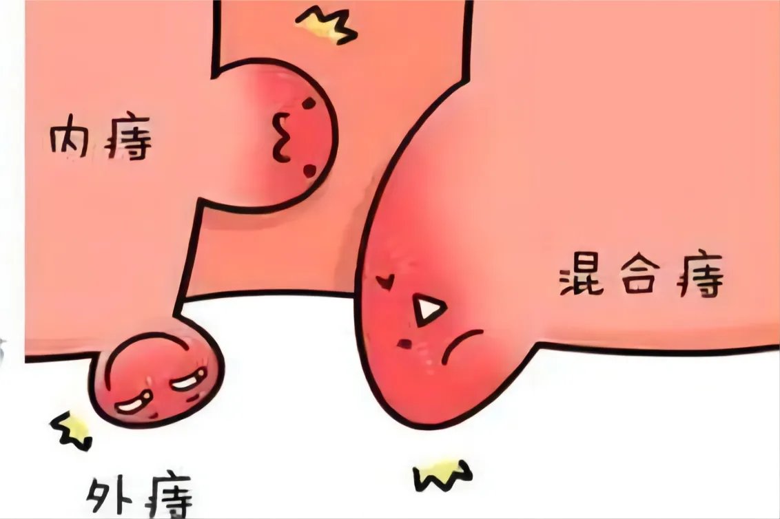痔疮是长什么样子的图片