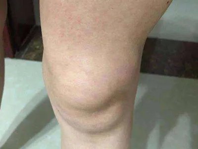 Ⅰ型痛性肥胖病症状图片