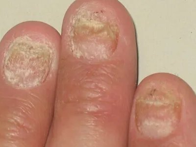 职业性指甲改变萎缩图片