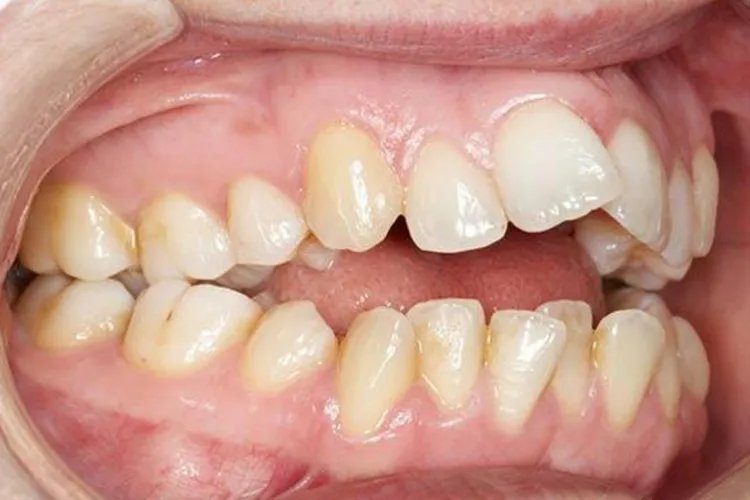 牙齿不平整图片