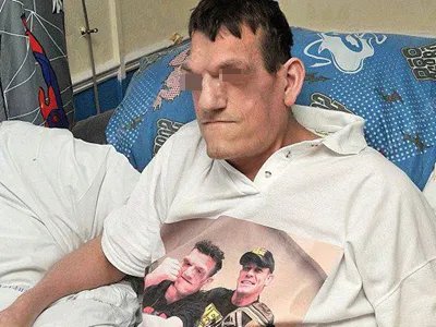 巨人症症状图片