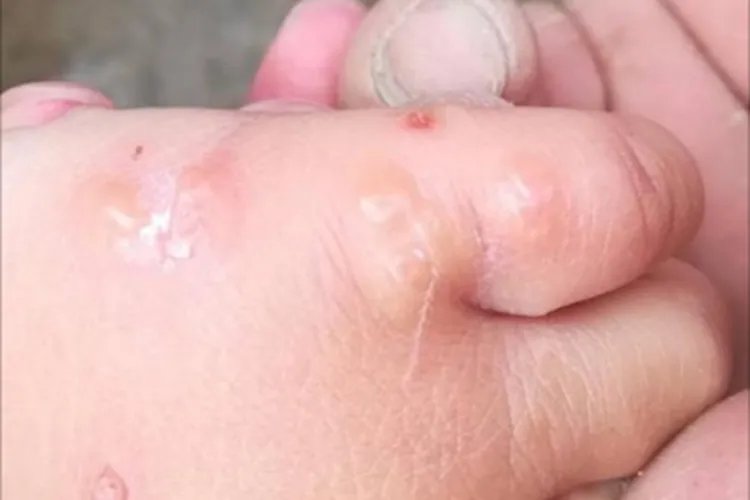 水疱型手癣症状图片