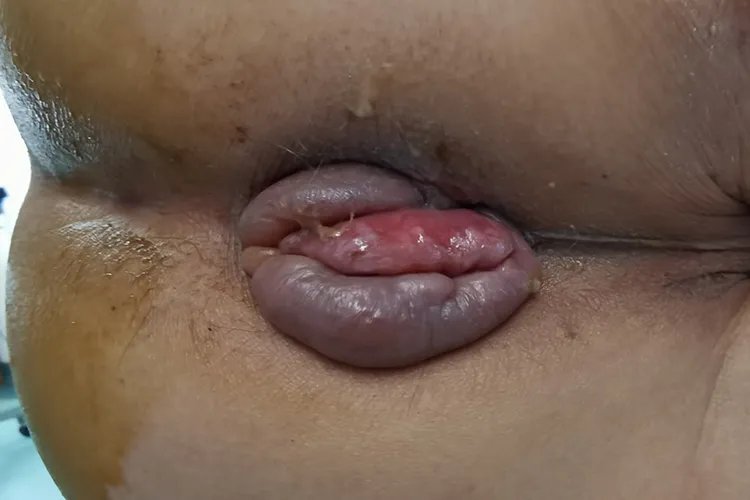 女性怎么判断自己得了痔疮图片