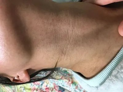 家族性进行性色素沉着症斑图片