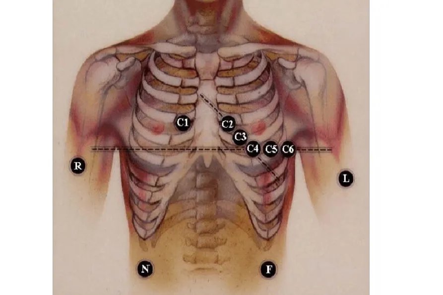 动态心电图十个贴片的位置图