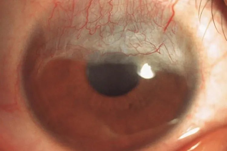 儿童角膜炎的症状图片