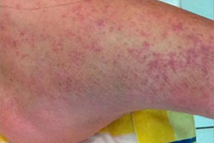 登革热症状图片