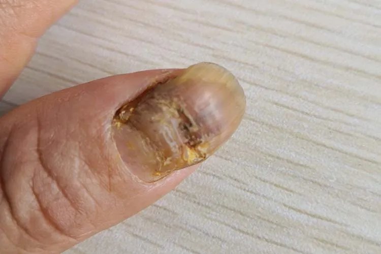 什么是灰指甲症状图片