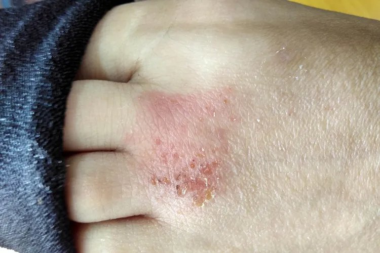 脚面上起了一片小红疹图片