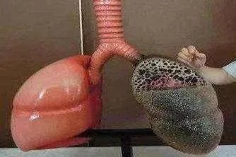 百草枯的肺纤维化实物图