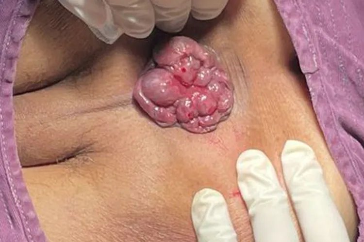 女性怎么判断自己得了痔疮图片