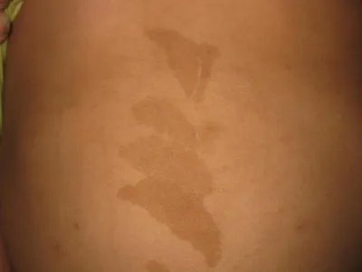 咖啡斑症状图片