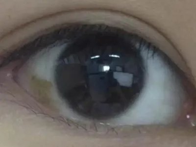 家族性进行性色素沉着症斑图片