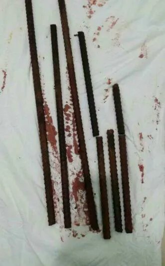 四根钢筋贯穿工人身体 多学科接力演绎生死大营救