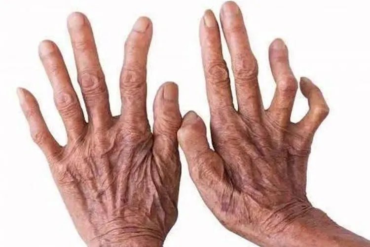 麻风病是什么病及图片