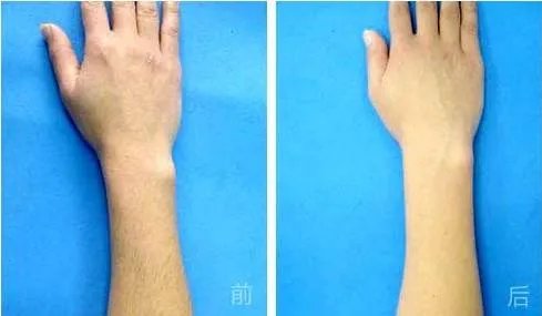 做光子脱毛哪家医院好